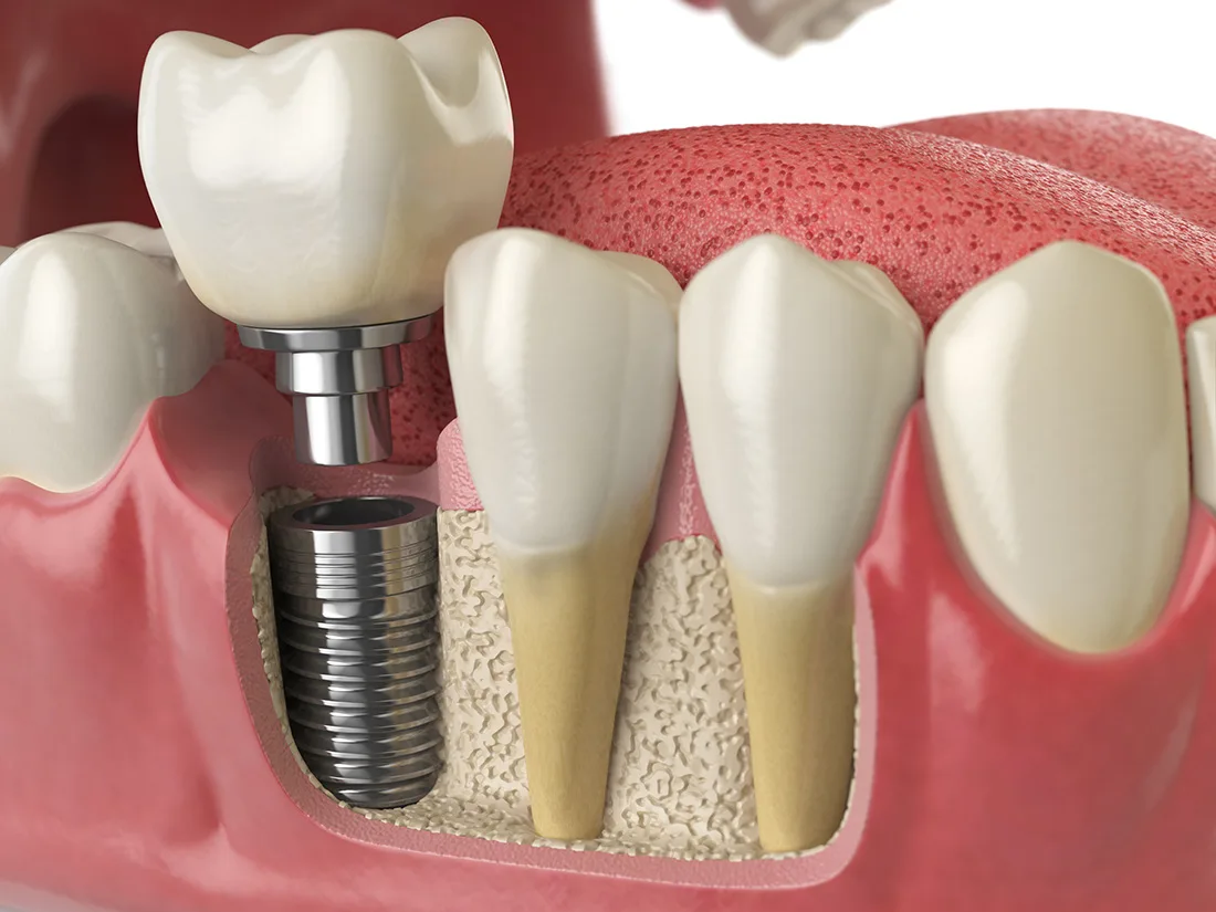 Dental Implants: A Long-Term Solution for Missing Teeth